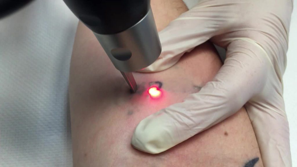 a person getting a laser tattoo
